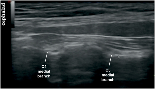 Usra Third Occipital Nerve And Cervical Medial Branch Block